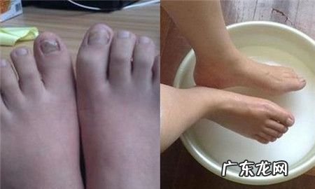 白醋泡脚去灰指甲要加水吗,用白醋泡脚怎么泡可以不加水
