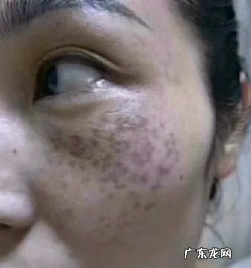如何去脸上的斑,如何去脸上的斑