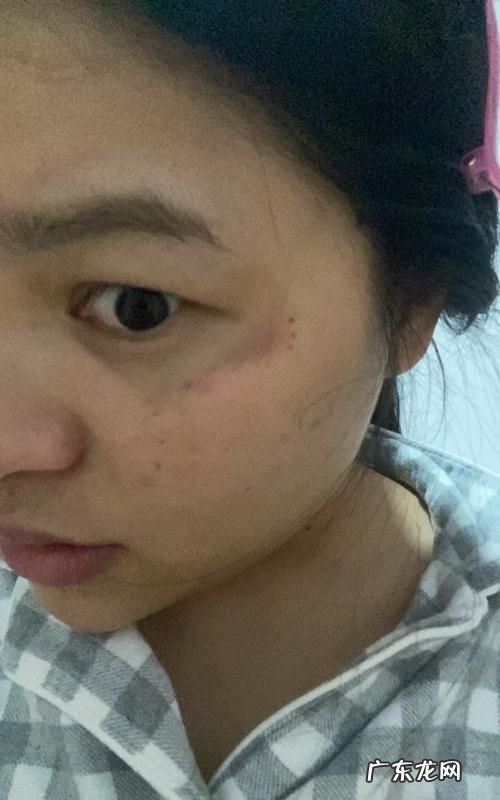 辐射长斑怎么办,辐射长斑怎么去除