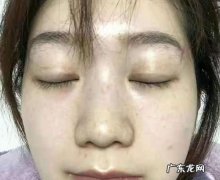辐射长斑怎么办,辐射长斑怎么去除