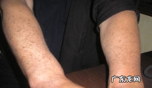 小苏打能去老年班,小苏打如何去斑点