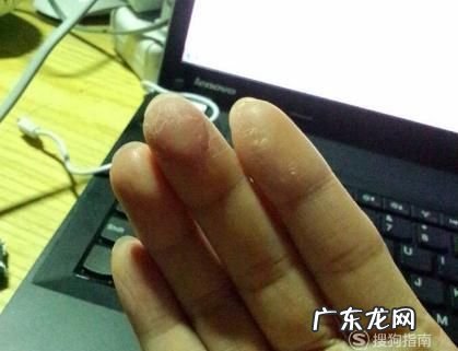 502在手上硬了怎么去除,502胶水滴到手上怎么办 洗掉502胶水的办法