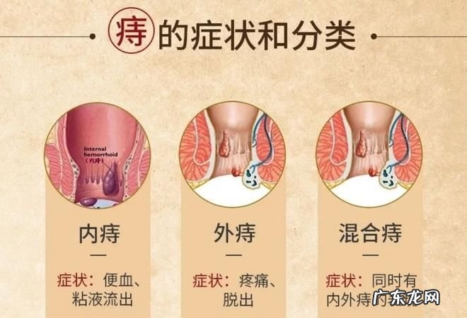 避免痔疮出血的方法推荐给大家,预防痔疮出血的措施有哪些