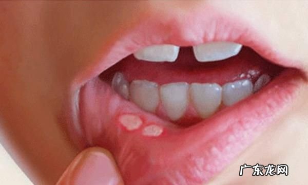 口腔溃疡缺什么,得了口腔溃疡怎么好得快