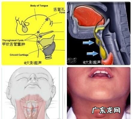 舌管囊肿有什么危害,甲状腺舌管囊肿不手术可以