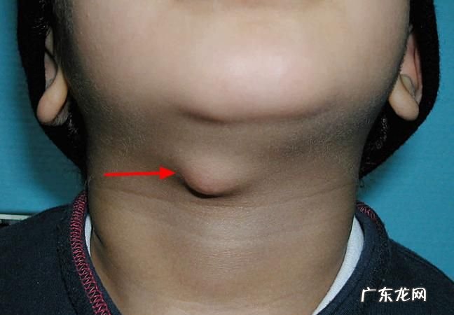舌管囊肿有什么危害,甲状腺舌管囊肿不手术可以