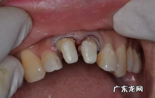 假牙被打掉了属于伤害,打掉假牙构成轻伤