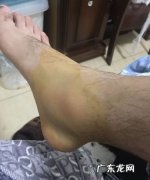 脚踝消肿的方法,脚踝消肿的最快方法