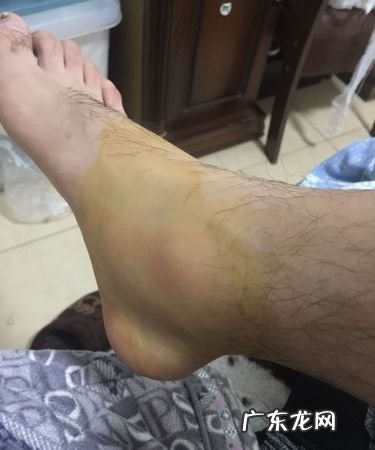 脚踝消肿的方法,脚踝消肿的最快方法
