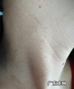 脖子上长小瘊子怎么办,脖子上长丝状疣怎么去除