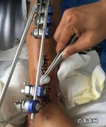 前臂粉碎性骨折工伤怎么赔偿,工地受伤粉碎性骨折怎么赔偿多少钱