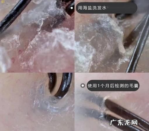 头发为什么有螨虫,头上有螨虫是什么原因造成的