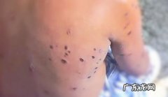 被马蜂蛰了怎么处理,马蜂蛰了怎么处理方法