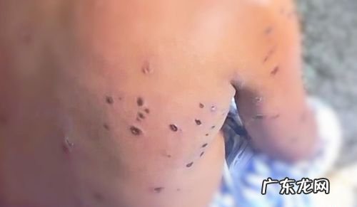 被马蜂蛰了怎么处理,马蜂蛰了怎么处理方法
