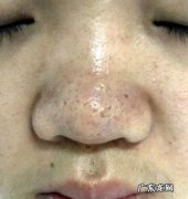 挤黑头留下的黑印能去掉,脸上挤黑头留下了一块黑印怎么办