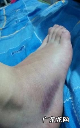 脚歪着了怎么处理最好,崴了脚怎么在家处理的方法
