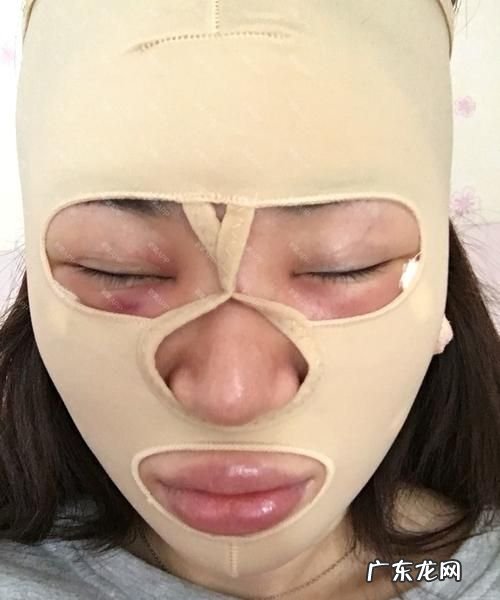 面部吸脂怎么样,面部吸脂好不好看