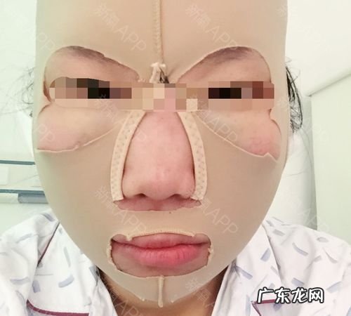 面部吸脂怎么样,面部吸脂好不好看