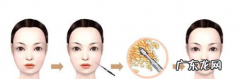 面部吸脂怎么样,面部吸脂好不好看