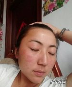 经常过敏怎么办,身体过敏了怎么办最快方法止痒