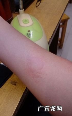 经常过敏怎么办,身体过敏了怎么办最快方法止痒