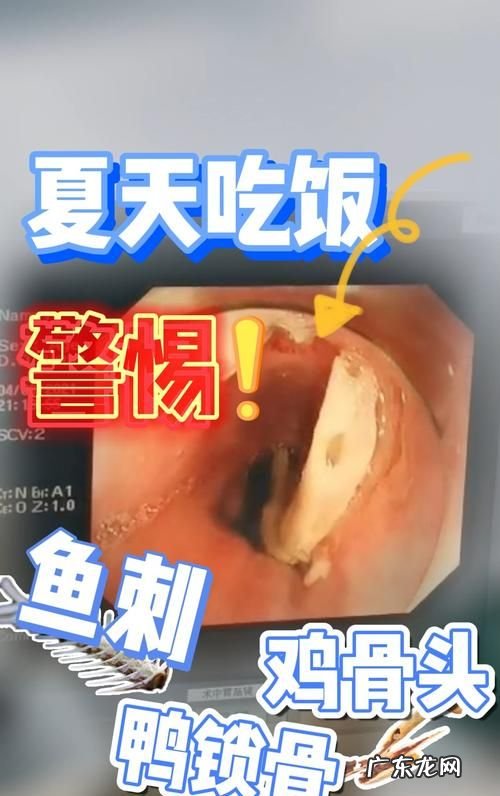 鱼刺扎在喉咙里该怎么办,鱼刺在喉咙里怎么办
