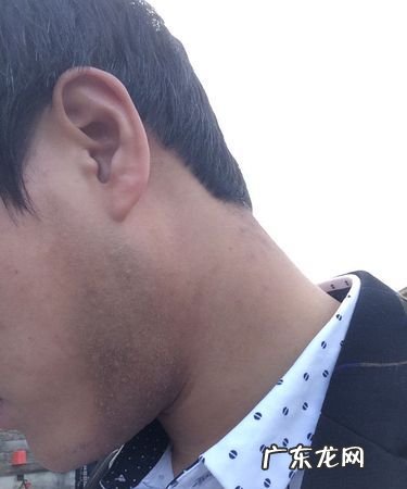 胡子上的黑印怎么样去掉,刮胡子后挂得太狠长期后留下的淡淡黑印怎么去除