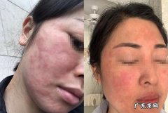 怎么区分敏感肌还是激素脸,激素脸和过敏脸的区别在哪