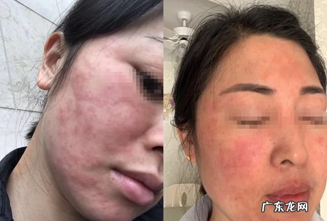 怎么区分敏感肌还是激素脸,激素脸和过敏脸的区别在哪