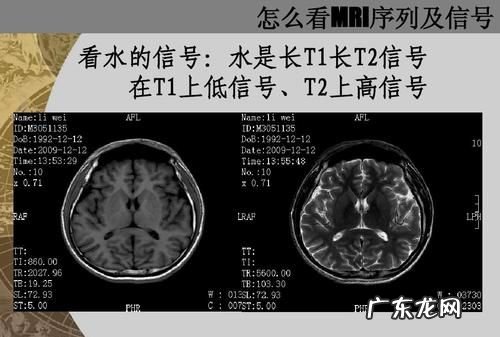磁共振tt2信号怎么看,长短t与t2的区别口诀