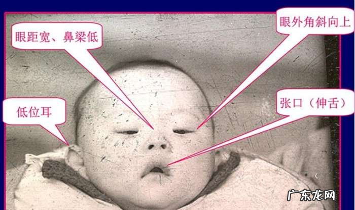 什么叫唐氏儿,唐氏儿筛查是什么意思
