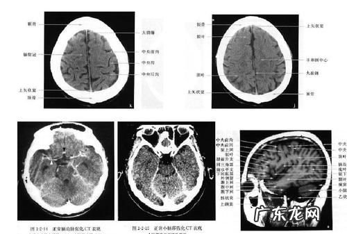 如何看懂磁共振片子,磁共振片子出了报告没出可以看医生