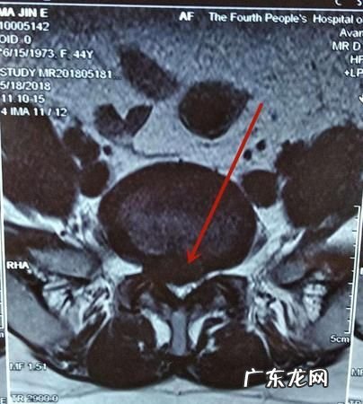如何看懂磁共振片子,磁共振片子出了报告没出可以看医生