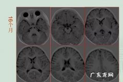 如何看懂磁共振片子,磁共振片子出了报告没出可以看医生