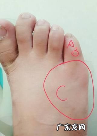 脚小拇指为什么有两瓣,脚的小拇指有两个指甲 是为什么