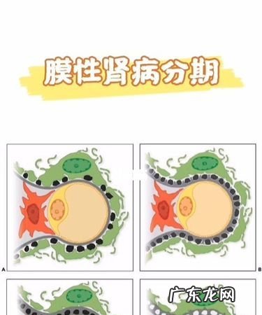 膜性肾病可以买保险,膜性肾病能过夫妻生活