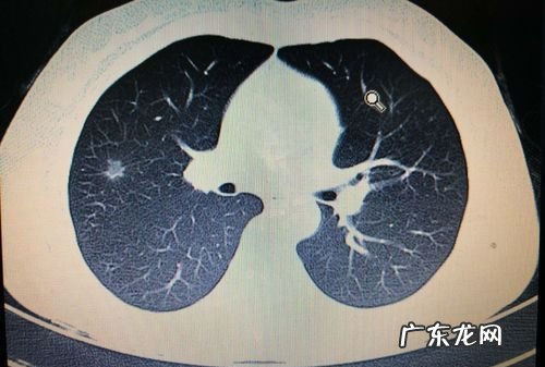 得了肺部小结节怎么办,肺部小结节是怎么回事要紧