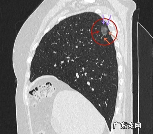 得了肺部小结节怎么办,肺部小结节是怎么回事要紧