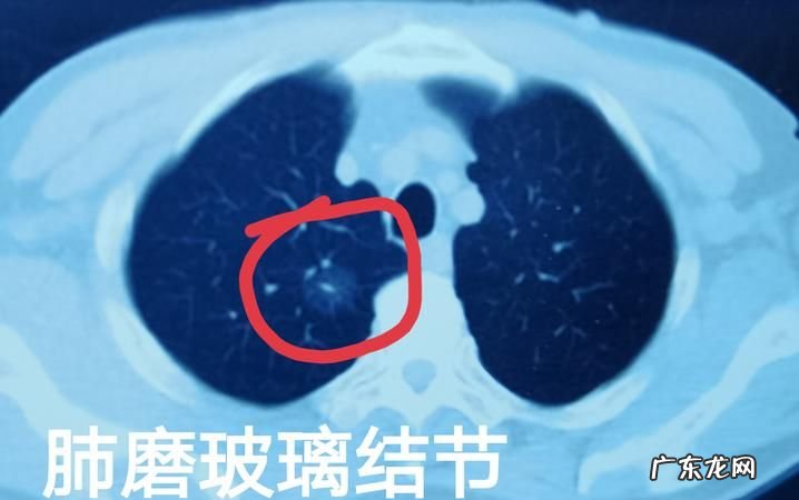 得了肺部小结节怎么办,肺部小结节是怎么回事要紧