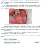 口腔扁平苔藓是什么病,口腔扁平苔藓是什么原因引起的