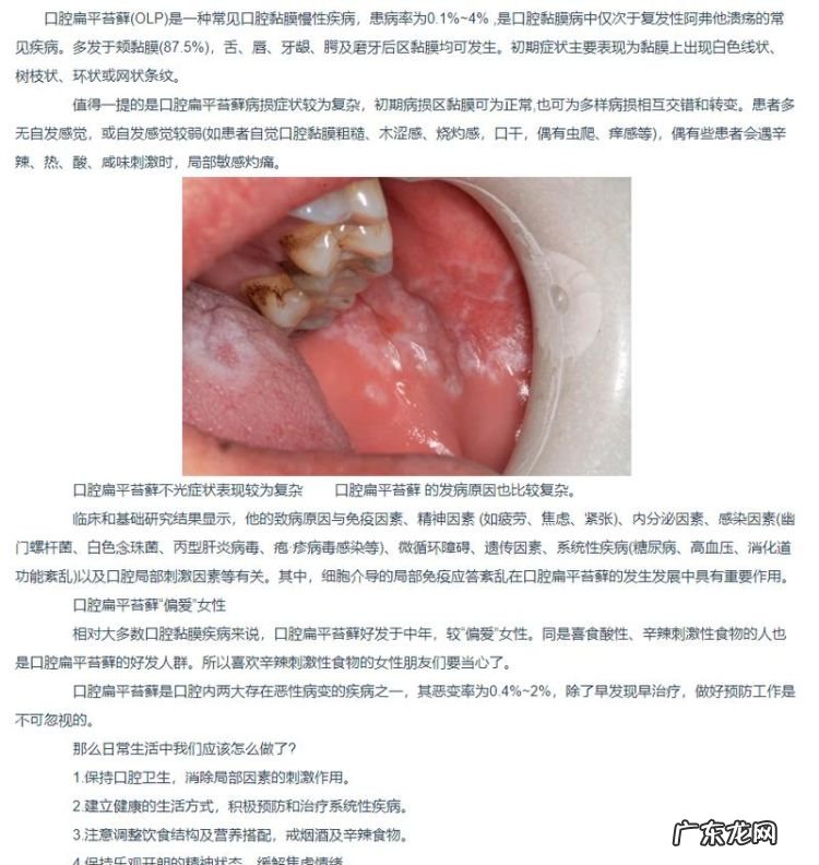口腔扁平苔藓是什么病,口腔扁平苔藓是什么原因引起的