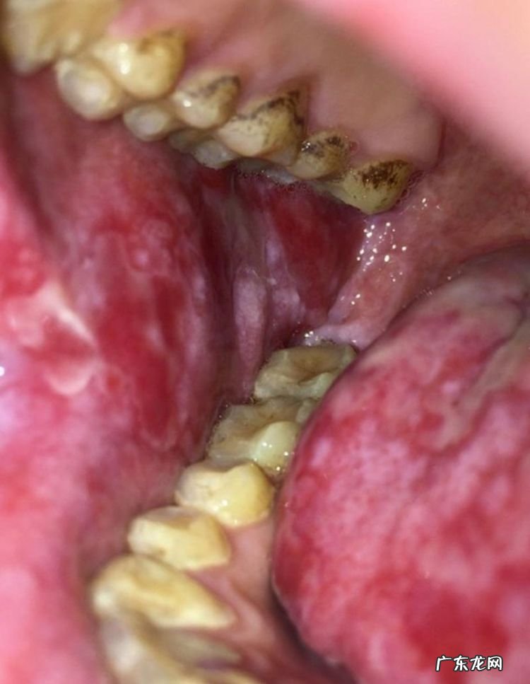 口腔扁平苔藓是什么病,口腔扁平苔藓是什么原因引起的