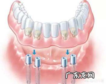 70岁适合种植牙,我爸今年72岁了怎么白天总是心烦坐立难安是什么原因