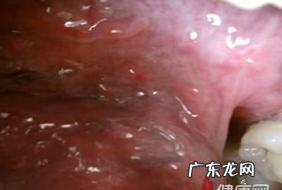 女尖锐湿尤是怎么引起的,女性得了尖锐湿是什么原因引起的