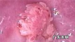 女尖锐湿尤是怎么引起的,女性得了尖锐湿是什么原因引起的