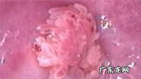 女尖锐湿尤是怎么引起的,女性得了尖锐湿是什么原因引起的