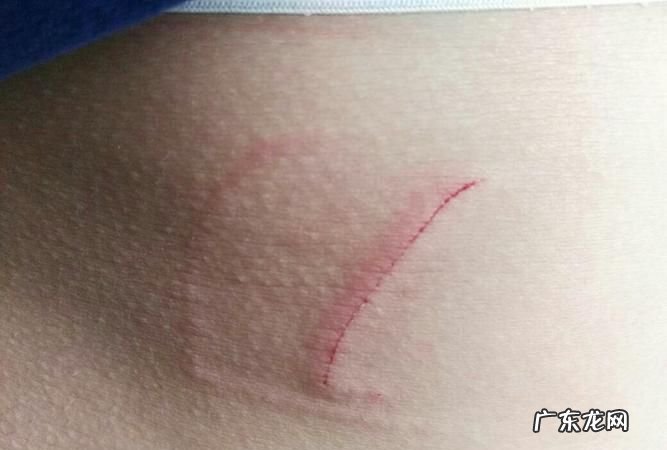 被狗狗抓伤怎么办,被小狗狗抓伤了怎么办
