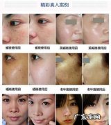 黄褐斑和雀斑的区别,雀斑黄褐斑怎么区分