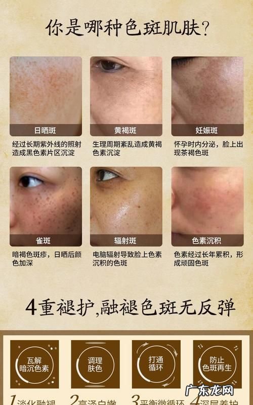 黄褐斑和雀斑的区别,雀斑黄褐斑怎么区分
