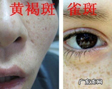 黄褐斑和雀斑的区别,雀斑黄褐斑怎么区分